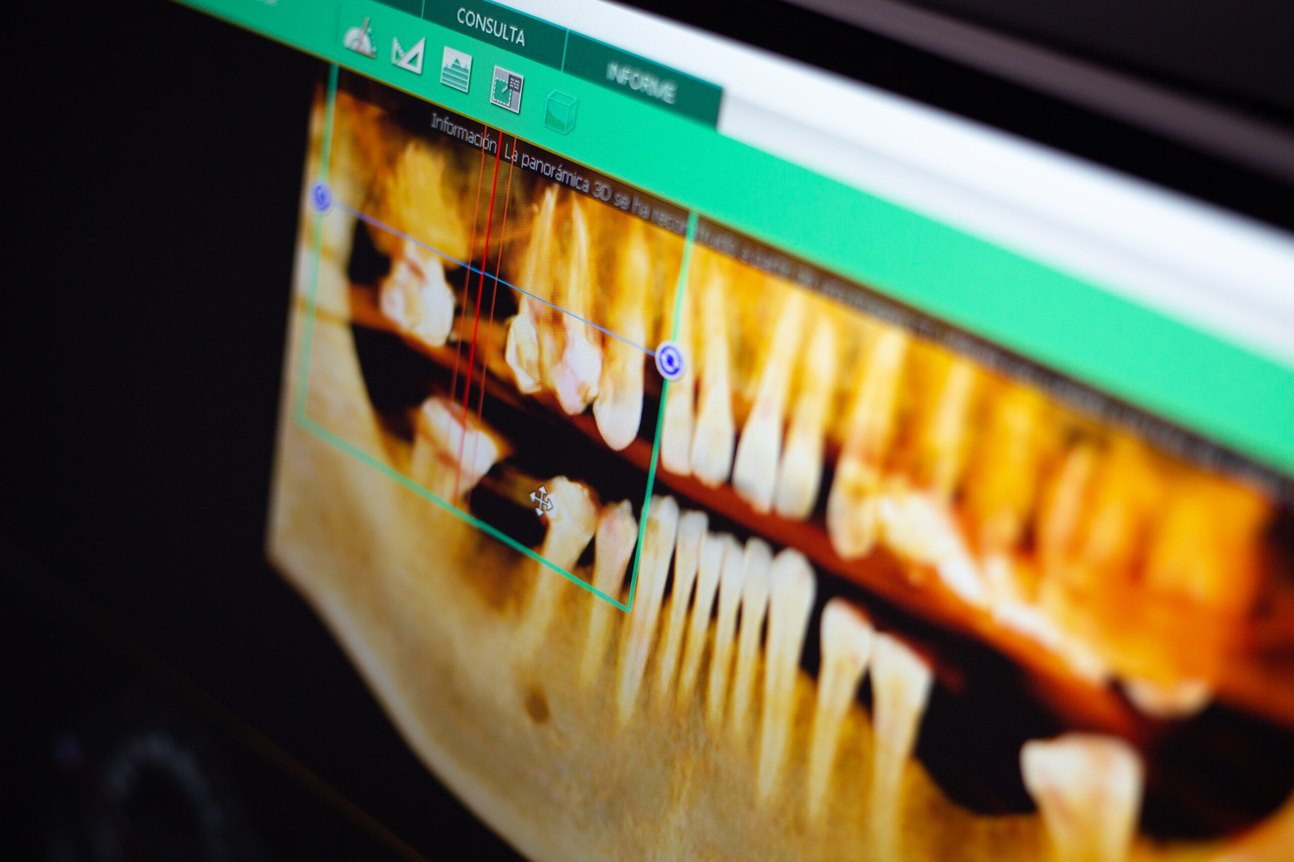 Una placa dental de un paciente de la clínica dental Puchol