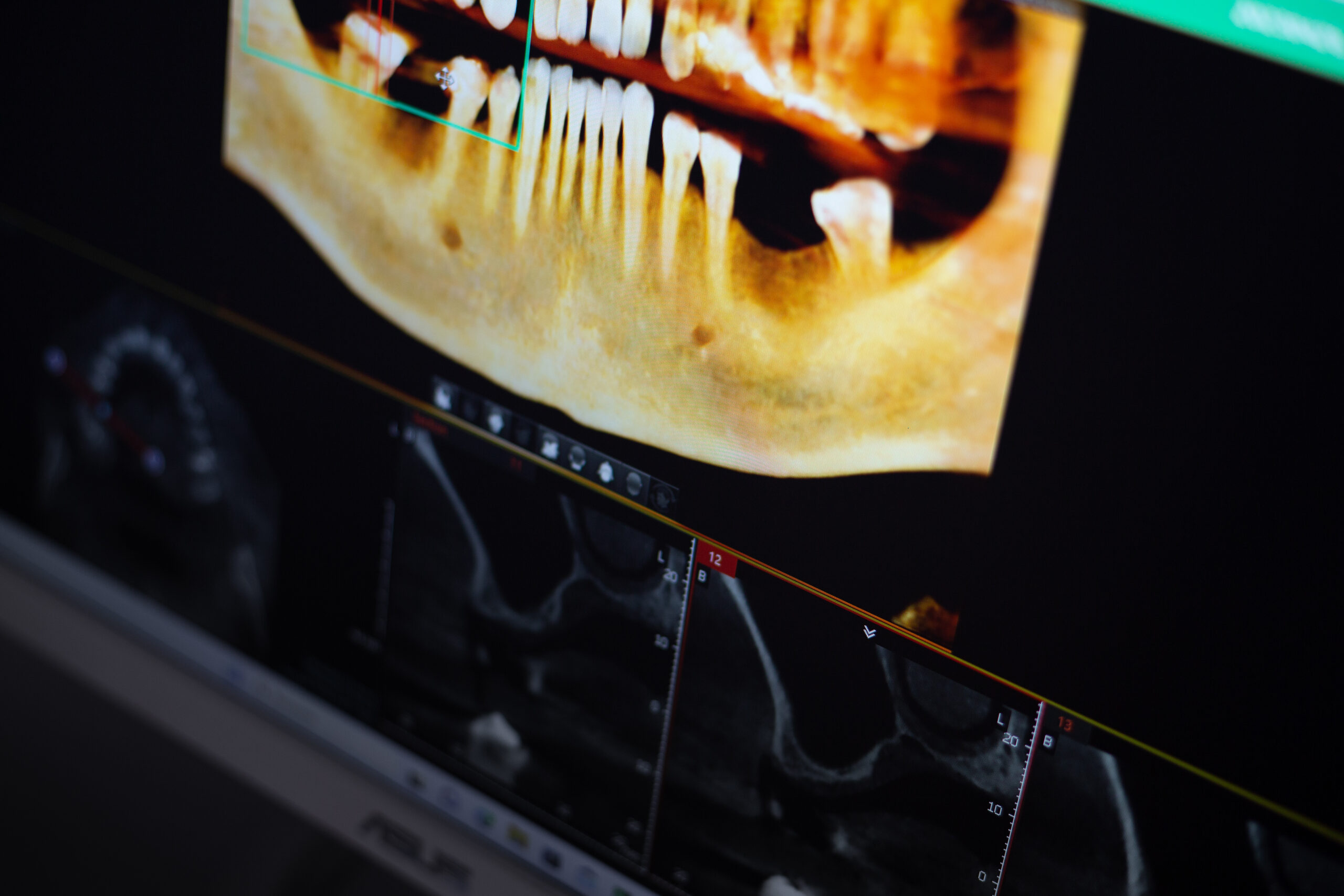 Una placa dental de un paciente de la clínica dental Puchol